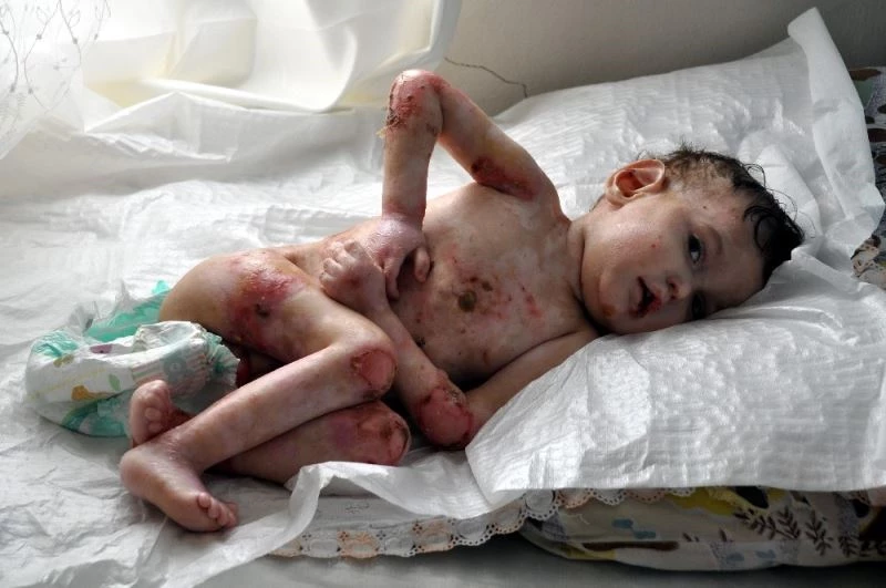 Vücudu yara içerisinde olan 3 yaşındaki çocuk yardım eli bekliyor
