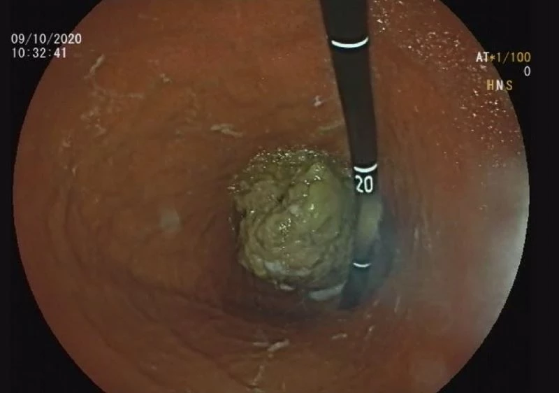 Çekirdekleriyle alıç tüketen 5 kişi hastanelik oldu
