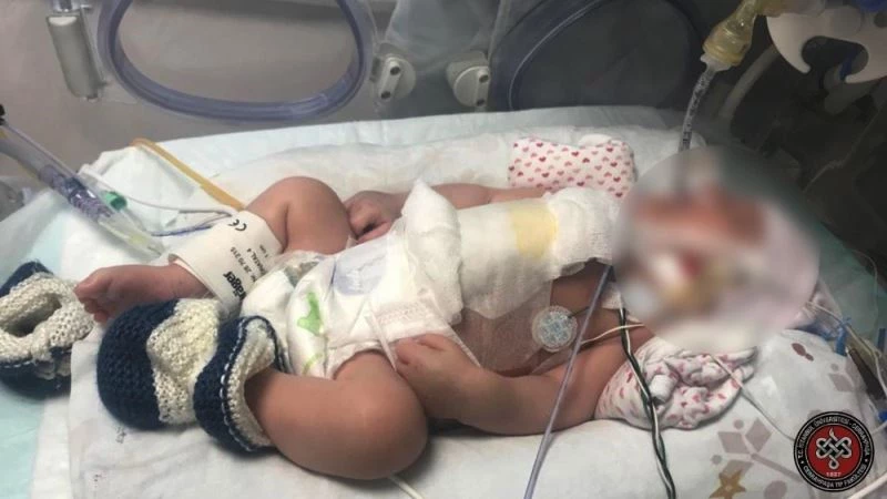 Yapışık ikizler 7 saat süren operasyonun ardından ayrıldılar
