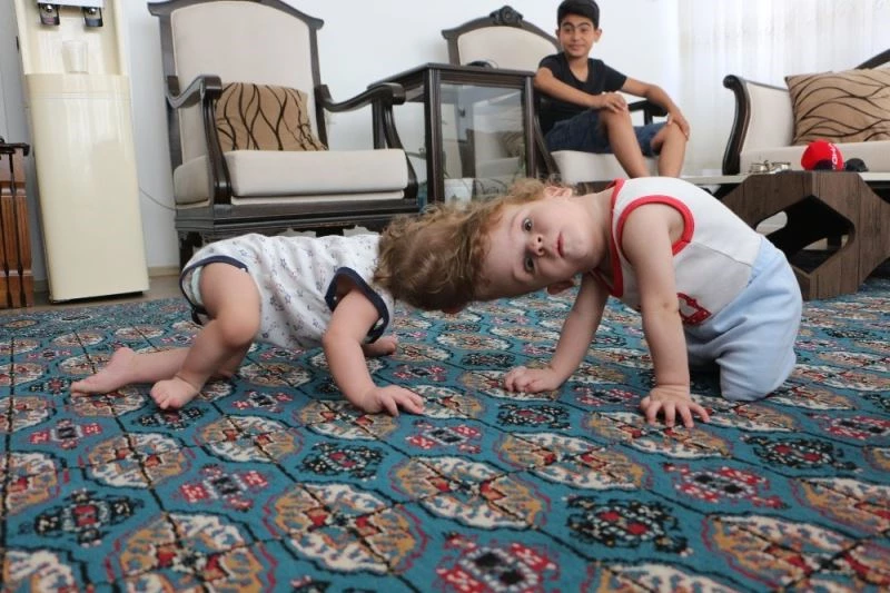 Antalyalı siyam ikizleri ayrıldı
