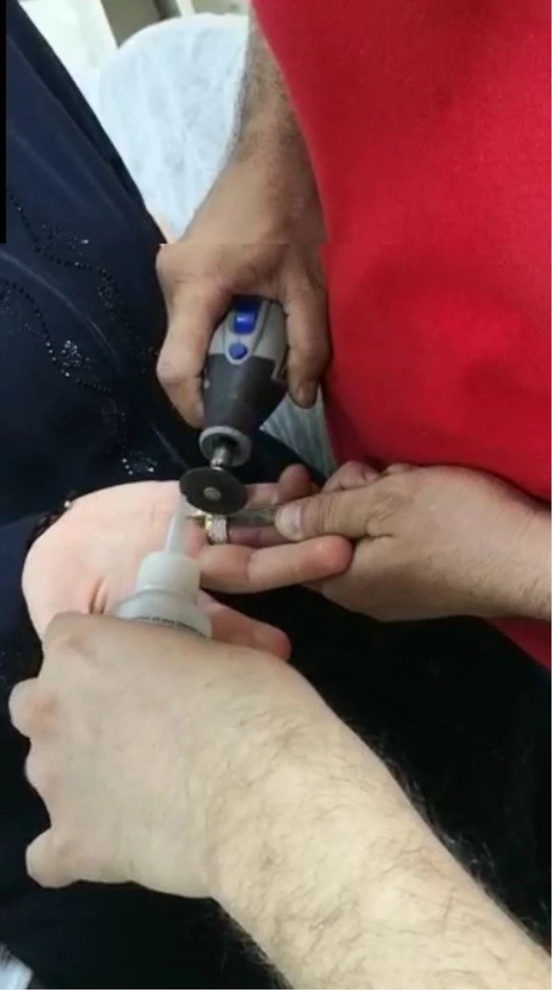 Kadının parmağındaki yüzük kesilerek çıkartıldı
