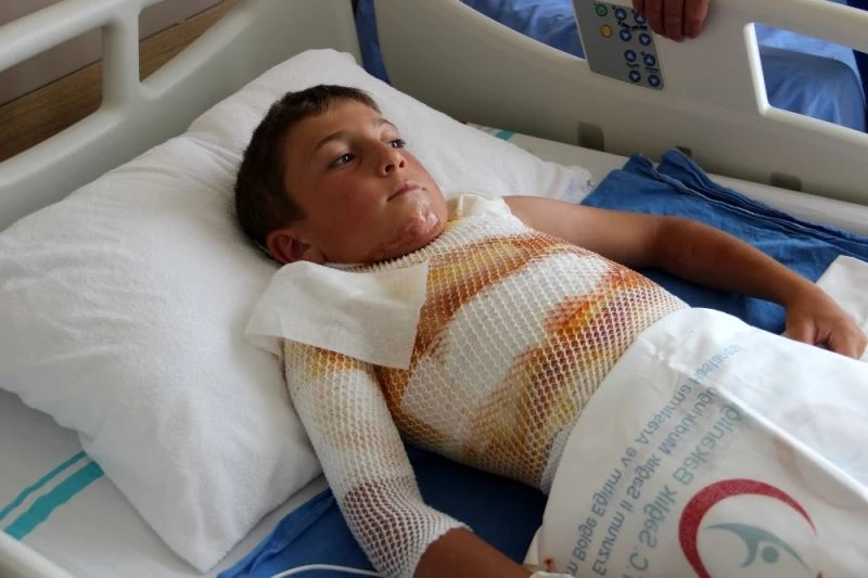 Gömleğindeki ipi yakmak isterken kendini yaktı
