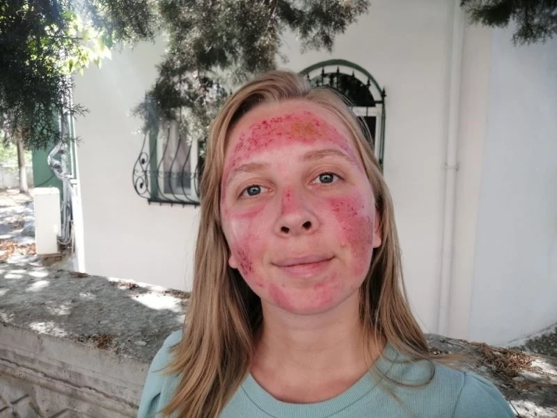 Cilt bakımı yaptıran kadının hayatı karardı
