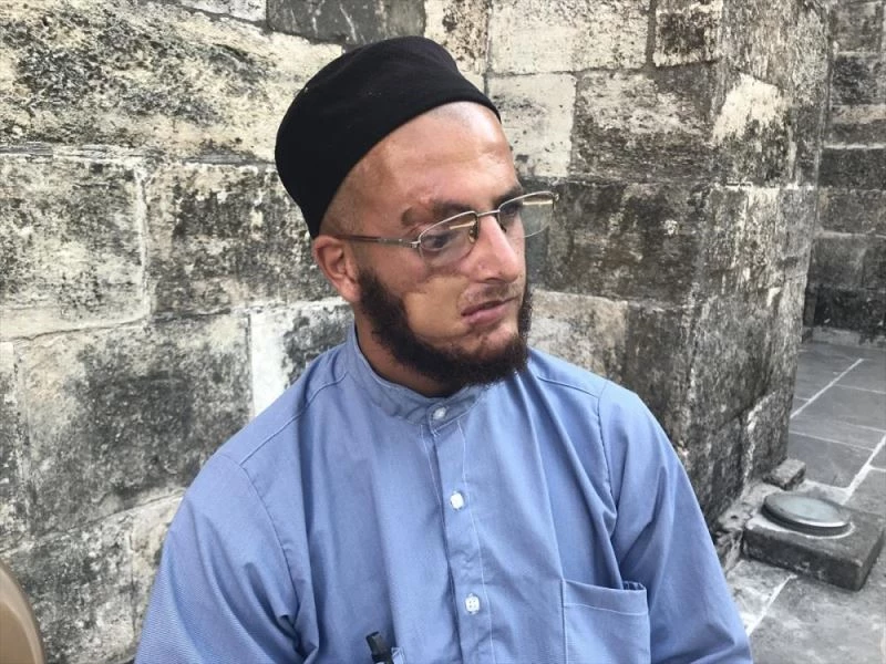 Yüzündeki yara izlerinden kurtulup çalışmak istiyor