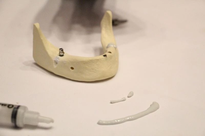 Kırık kemiklere sentetik kemik dolgusu ile 10 dakikada tedavi imkanı
