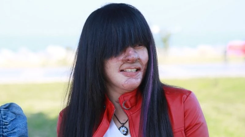 Yüzüne asit döken erkek arkadaşını affeden Berfin: “Bunu nasıl yapabildim”
