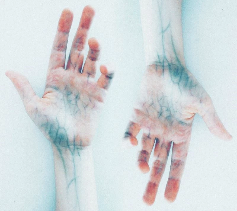 “Zümrüt lazeri ince kılcal damarlı varislerde tedavisinde kullanıyoruz”
