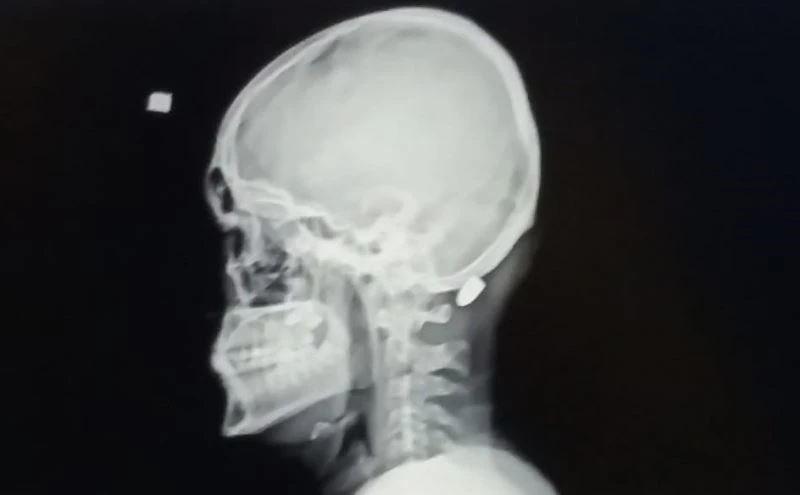 Trabzon’da havaya ateş etme geleneği can yakıyor
