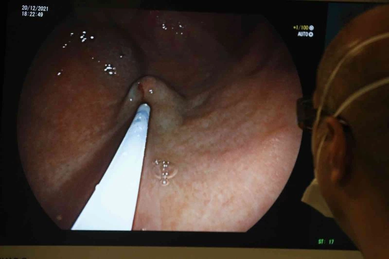 Mide botoksunda 15 dakikalık işlemle hastalar rutin yaşamlarına devam ediyor

