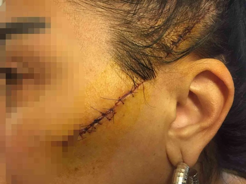 Eski sevgilisinin yüzünü usturayla kesen adam tutuklandı
