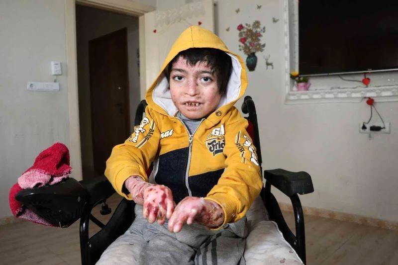 Kelebek hastası Seyfettin parmaklarına kavuştu
