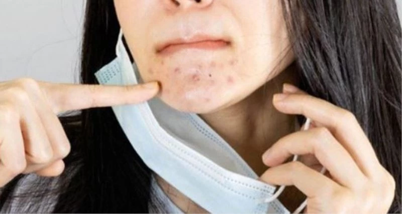 Maske sonrası artan cilt problemlerine önlem de çözüm de su
