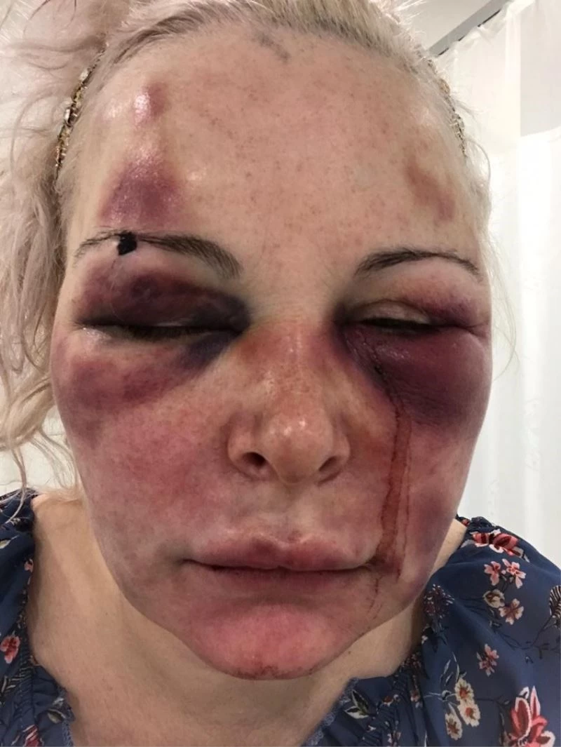 Otel odasında günlerce darp edilen Rus kadın konuştu: “Yaşamla ölüm arasındaydım”
