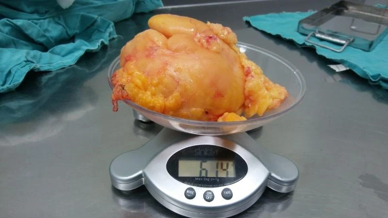 Kitle sebebi ile başvurdu dizinden 614 gram yağ bezesi çıkartıldı
