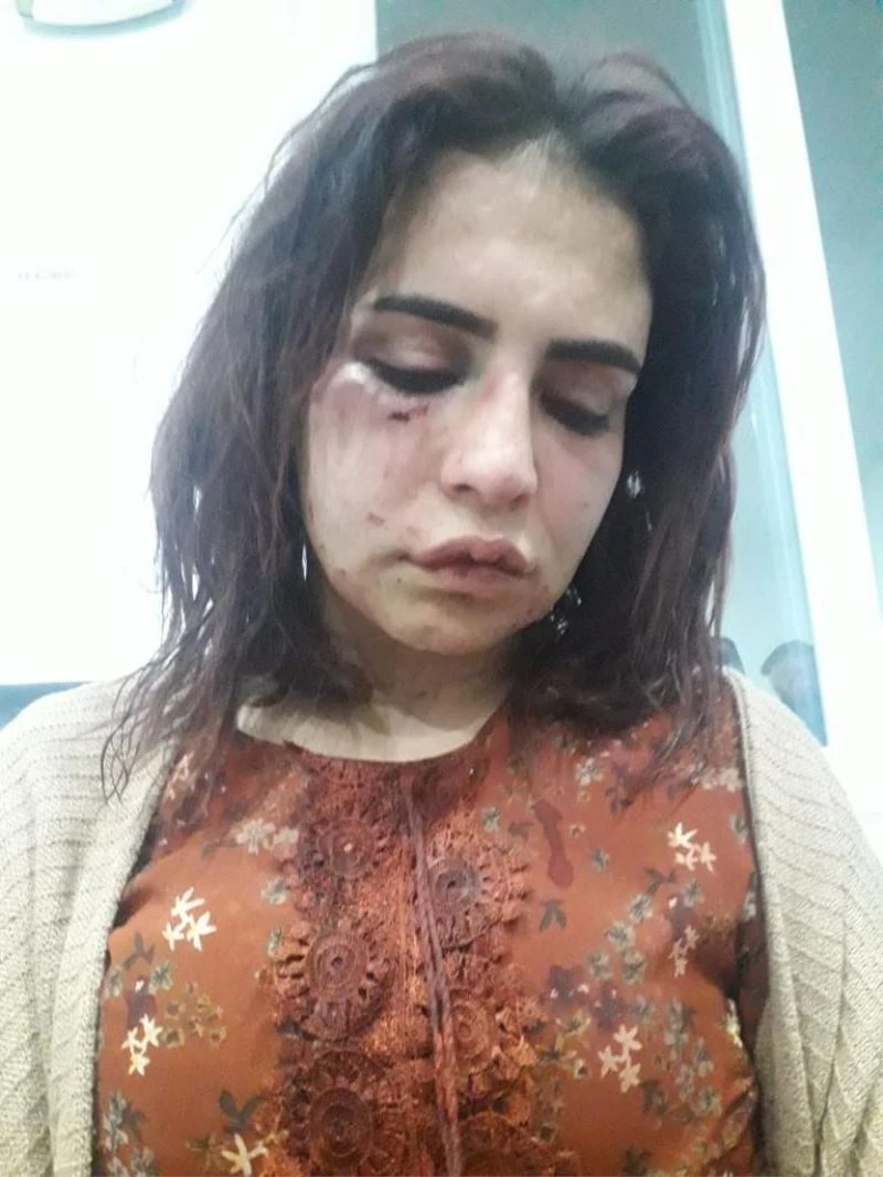 Eski sevgilisi tarafından darp edilen genç kızın “Ölmek istemiyorum” paylaşımı
