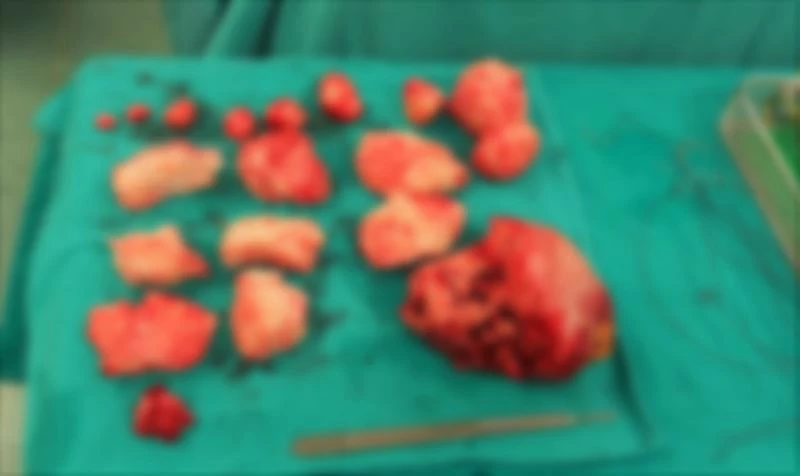 Şişkinlik sandı karnından 1,5 kilo miyom çıktı
