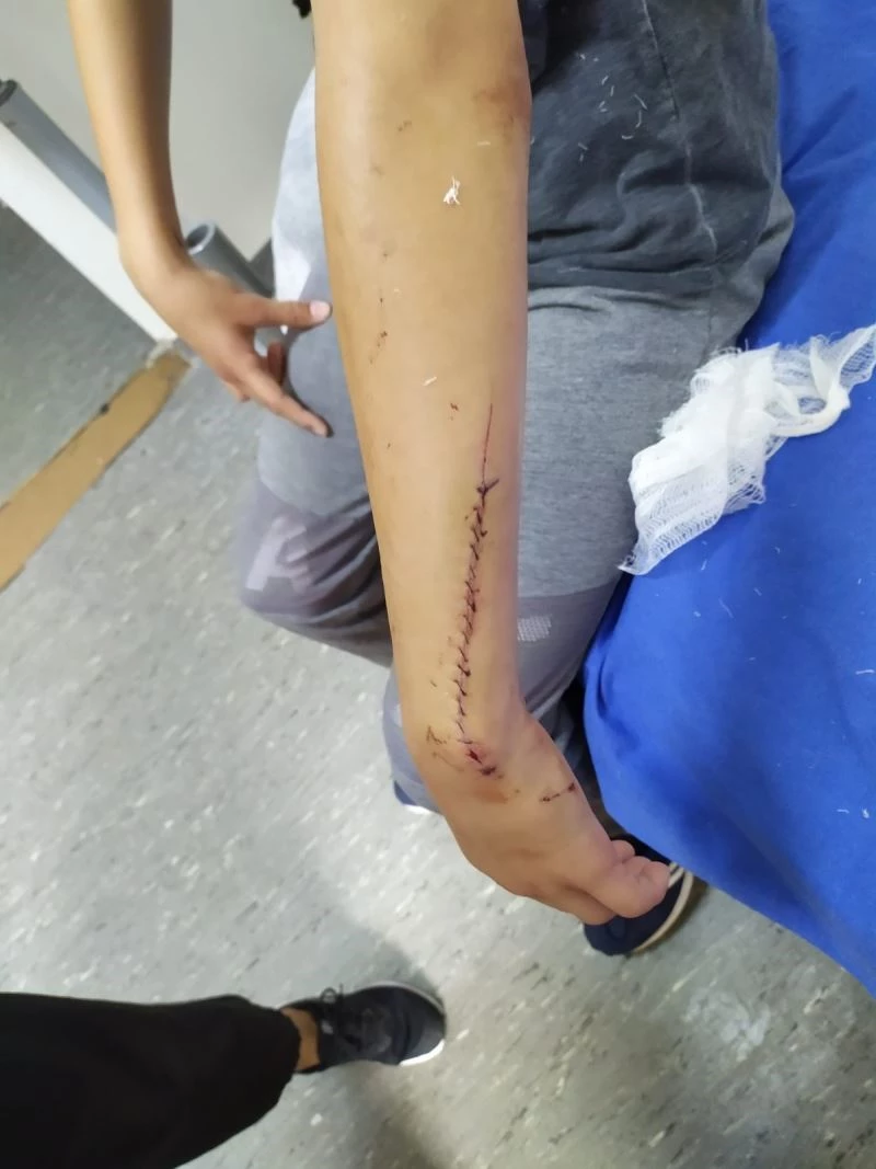 Yüzü ve kollarında kesikler oluşan çocuğa 70 dikiş atıldı
