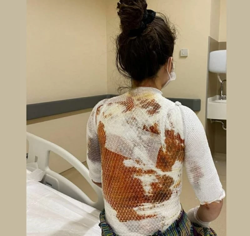 Eşinin kaynar suyla yaktığı Rukiye A: “Ölmek istemiyorum”
