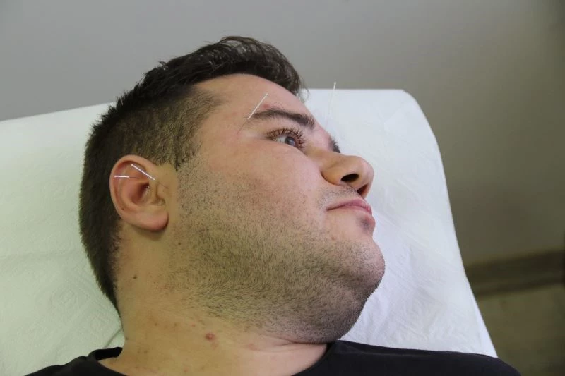 Fazla kilolara karşı akupunktur
