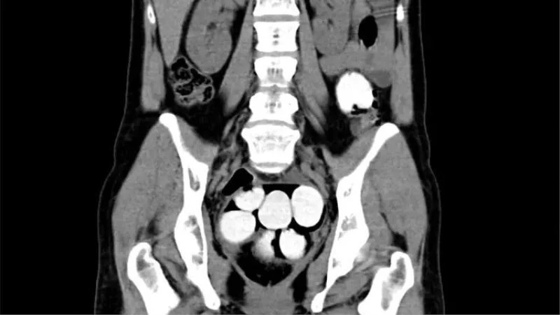İspanya’dan Çekya’ya gelen yolcunun midesinden yaklaşık 1,5 kilogram kokain çıktı
