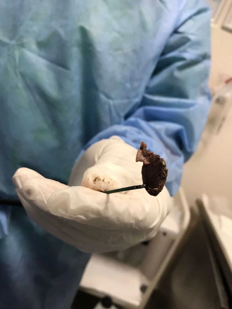 Öksürük şikayetiyle gitti, akciğerinden çekirdek çıktı
