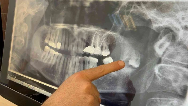 Kalıcı yüz felci olmaktan bu operasyonla kurtuldu
