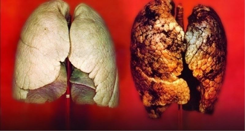 Akciğer kanserlerinin yaklaşık yüzde 90’ı tütün ve tütün ürünlerinin kullanımı ile oluşuyor
