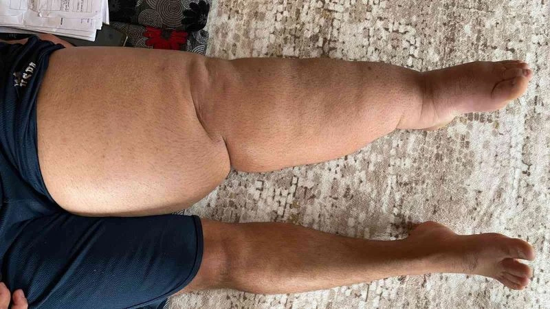 5 yıl önce tekstil fabrikasında kaza geçiren gencin ayağının şişmesiyle hayatı kabusa döndü
