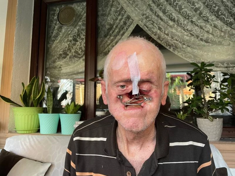 Burnu her gün milim milim eridi, 31 ameliyat geçirdi
