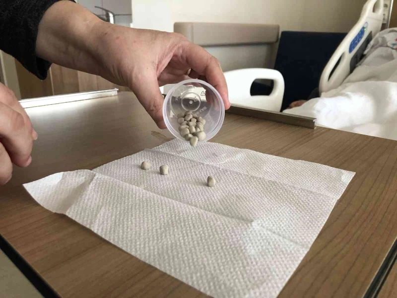 Mesanesinden 39 adet fındık büyüklüğünde taş çıktı
