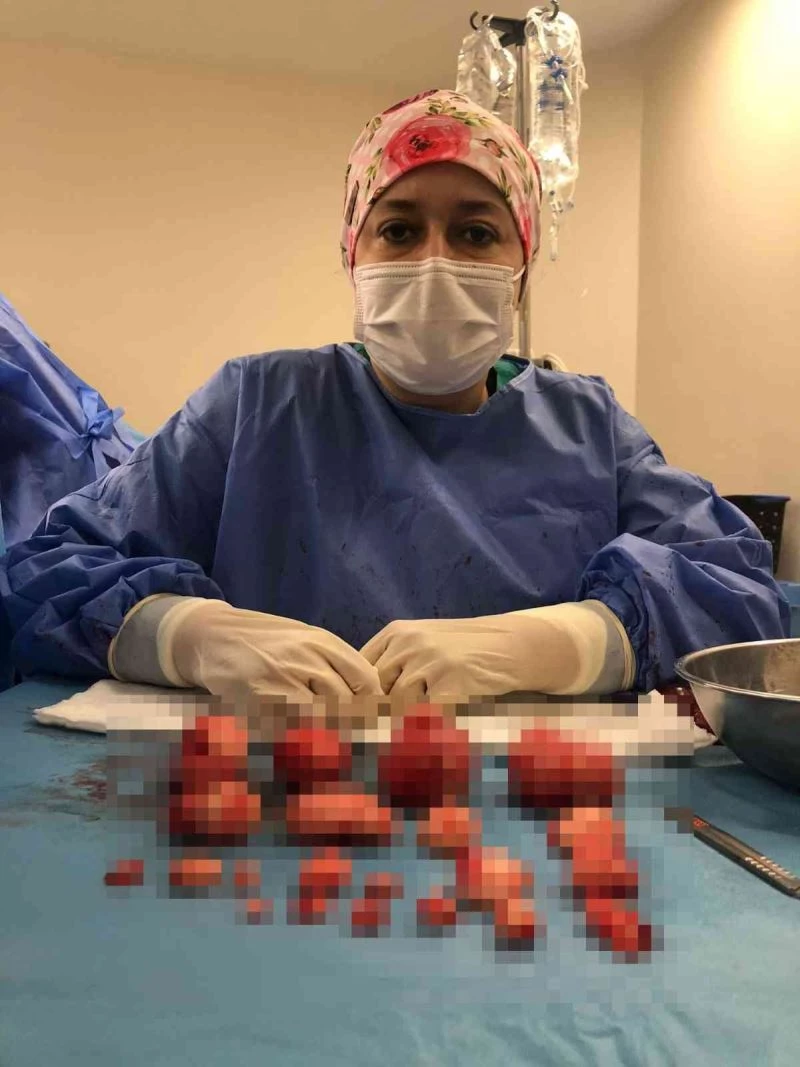 Bursa’da hastanın rahminden 21 miyom çıkarıldı
