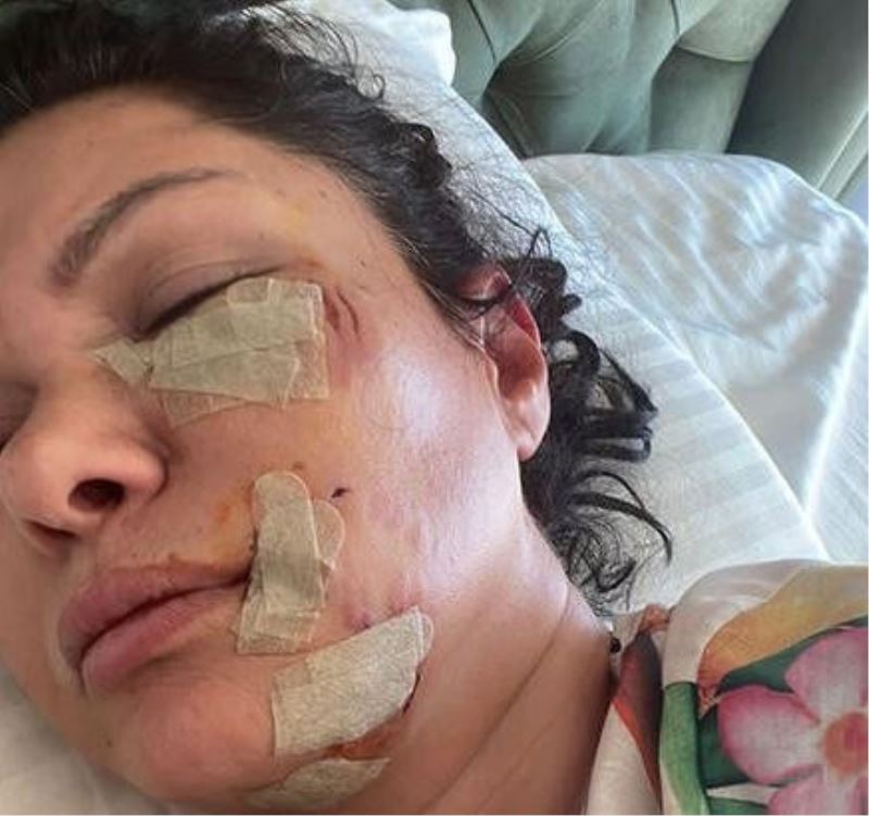 Ünlü şarkıcı Tuğba Altıntop köpek saldırısına uğradı
