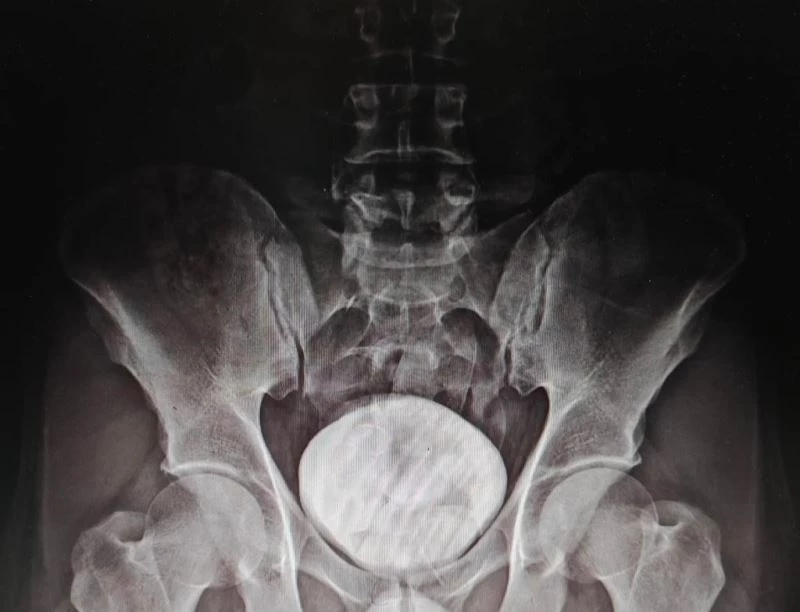 İran uyruklu şahsın mide ve bağırsaklarından uyuşturucu çıktı
