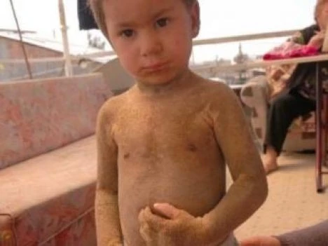 Vücudu timsaha benzeyen küçük Dila yardım bekliyor